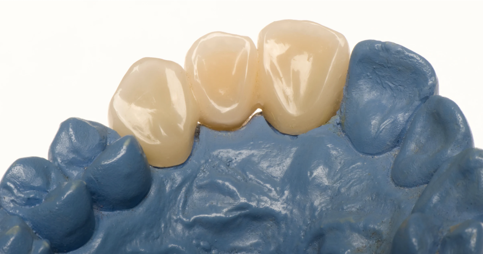 prothèse sur implant - dr alexandre lesnik - montpellier