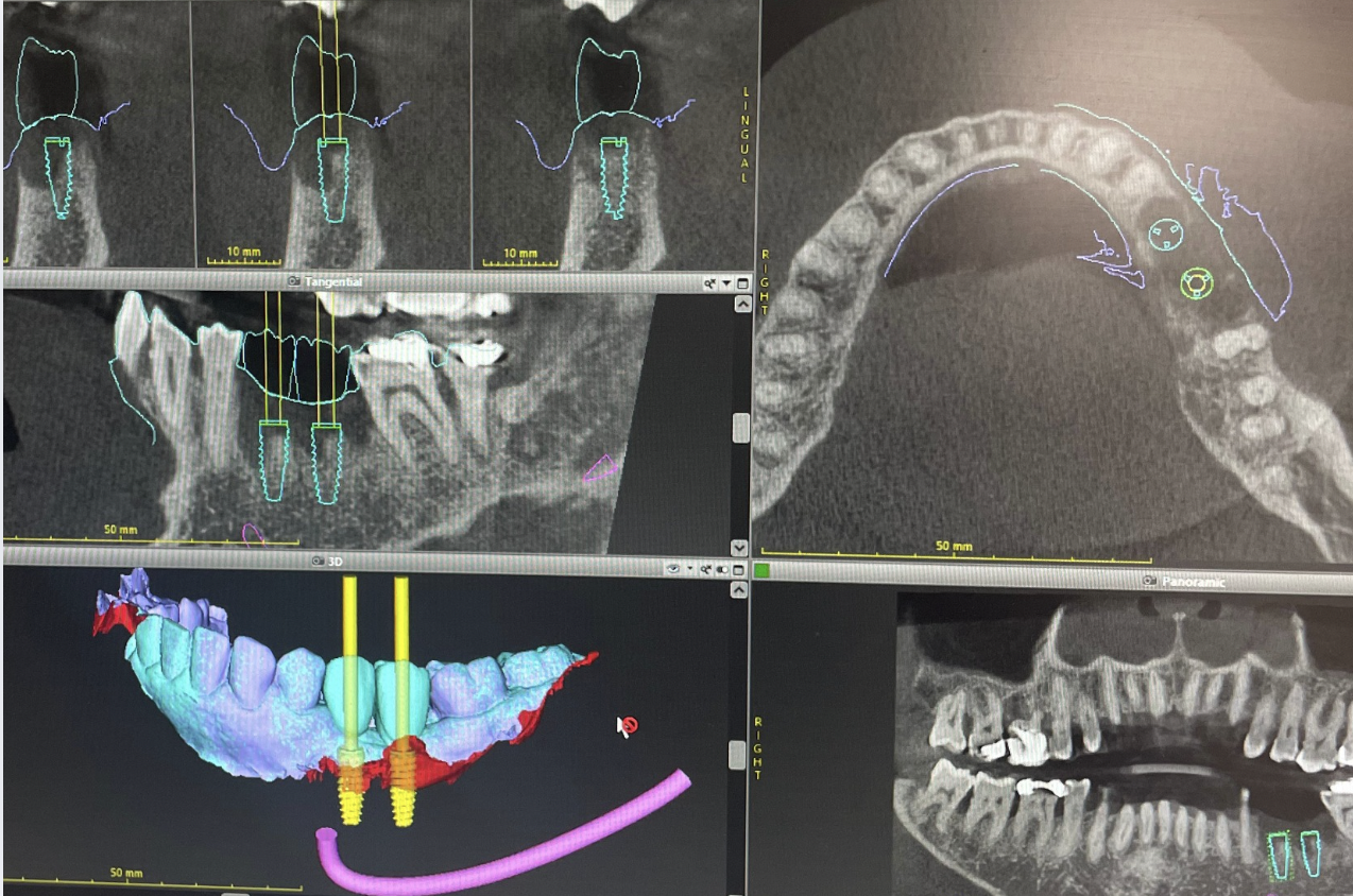 planification - implantologie guidée - montpellier - dr alexandre lesnik