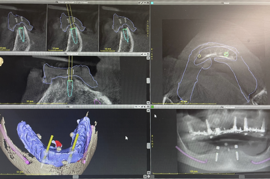 planification - implantologie guidée - montpellier - dr alexandre lesnik